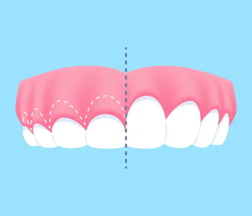 crown lengthening