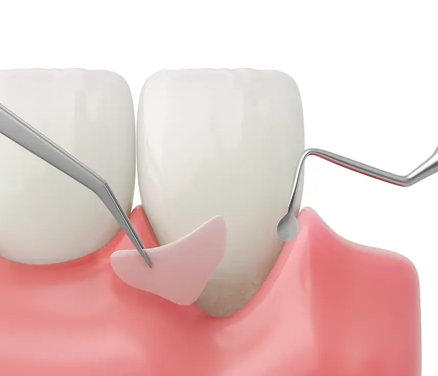 Gum Graft