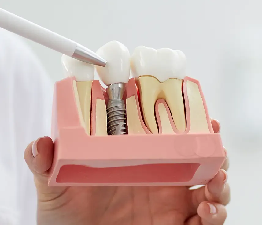 implant